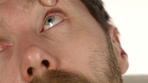 Maladie de Hordeolum dans l'oeil, l'homme goutte à goutte traitement à son oeil. infection et inflammation des yeux. 4K — Video