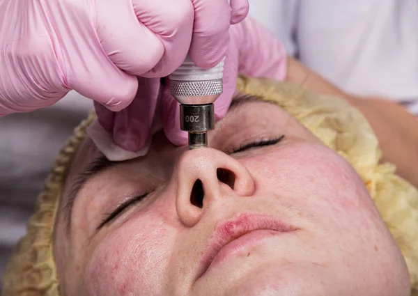 Mujer joven con problemas de piel, limpieza mecánica profunda de la cara. esteticista limpia la piel de las mujeres con equipo cosmético — Foto de Stock