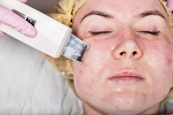 Beautician at work. Ultrasonic face cleaning procedure for problem skin. Pore cleansing, oxygen saturation for womans face — Stock Photo, Image