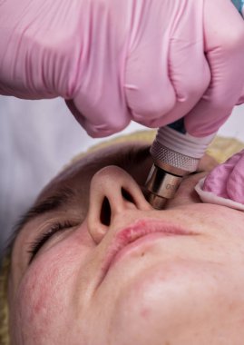 young woman with problem skin, mechanical deep face cleaning. beautician cleanses the womans skin with cosmetic equipment