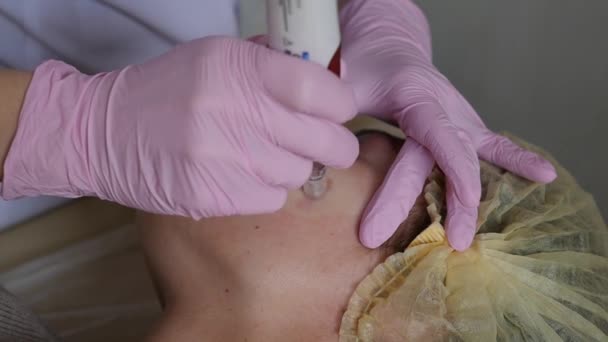 Procedura di cosmetologia di rimozione di posti di età in clinica cosmetology. Concetto di cura della pelle del viso . — Video Stock