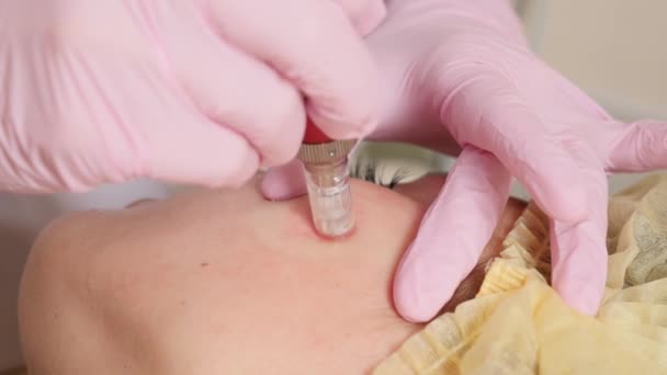 Cosmetologie procedure van ouderdomsvlekken verwijderen in cosmetologie kliniek. Concept gezichtsverzorging. — Stockvideo