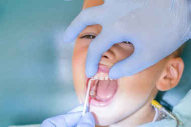 Çocuk Diş Kliniği inceleyerek dişçi. Küçük bir hastada diş sandalye gülümsüyor. Dantist diş davranır. diş hekimi diş dişçi ofisinde küçük çocuk tedavi görünümünü kapat