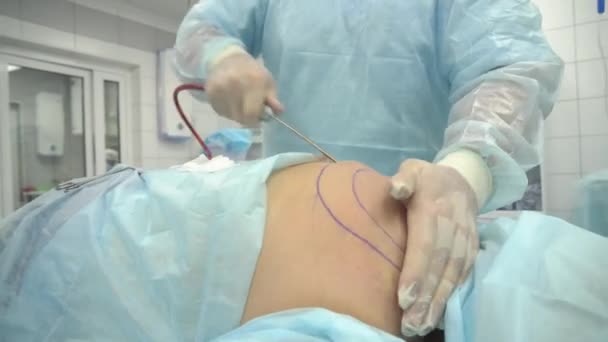 Operação de lipoaspiração. Médico recolhe gordura das costas torácicas — Vídeo de Stock