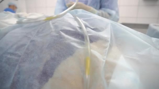 Operace, liposukce. Doktor shromažďuje tuk od hrudní zad — Stock video