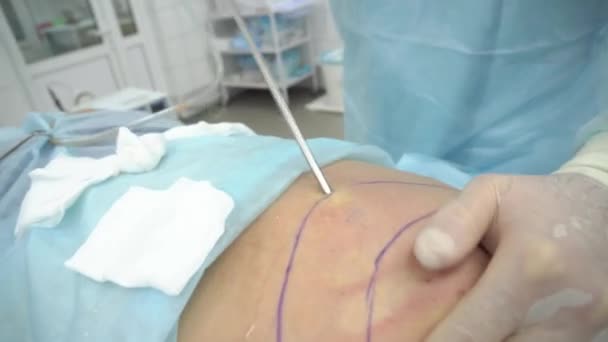 Operación de liposucción. Doctor recoge la grasa de la espalda torácica — Vídeos de Stock