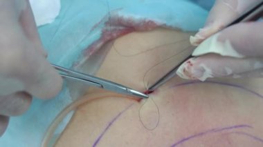 Liposuction işlemi. Doktor yağ torasik arkadan toplar. Yakın çekim görünümü