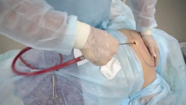 Операция липосакции. Доктор собирает жир из грудной клетки. — стоковое видео