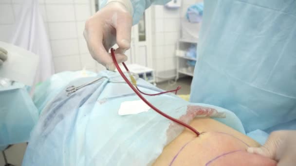 Operace, liposukce. Doktor shromažďuje tuk od hrudní zad — Stock video