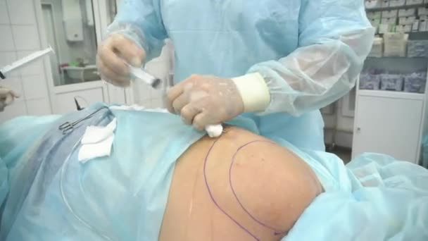 Operace, liposukce. Doktor shromažďuje tuk od hrudní zad — Stock video