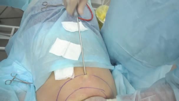 Liposuction operation. Doctor collects fat from the thoracic back — Stock Video