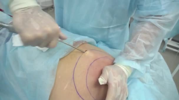 Operace, liposukce. Doktor shromažďuje tuk od hrudní zad — Stock video