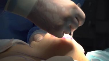 Cerrahi bir kadın meme şeklini değiştirmek için.