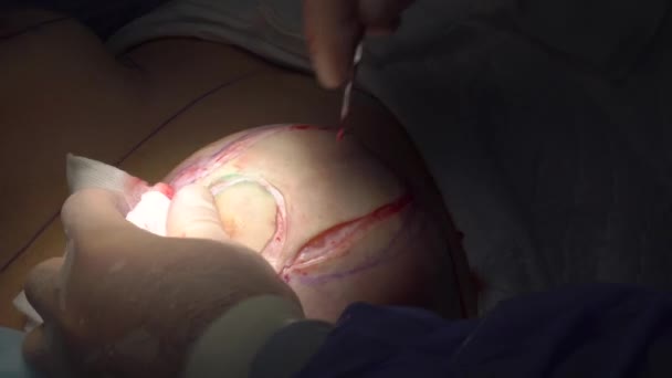 Операция по изменению формы груди у женщины . — стоковое видео