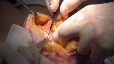 Cerrahi bir kadın meme şeklini değiştirmek için.