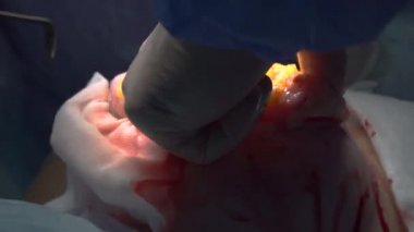 Cerrahi bir kadın meme şeklini değiştirmek için.