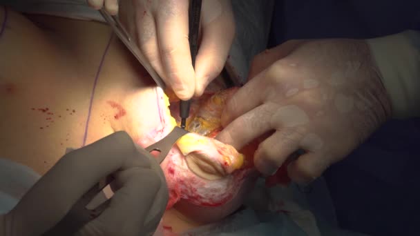 Extraction of an old implant from a breast — Stock Video