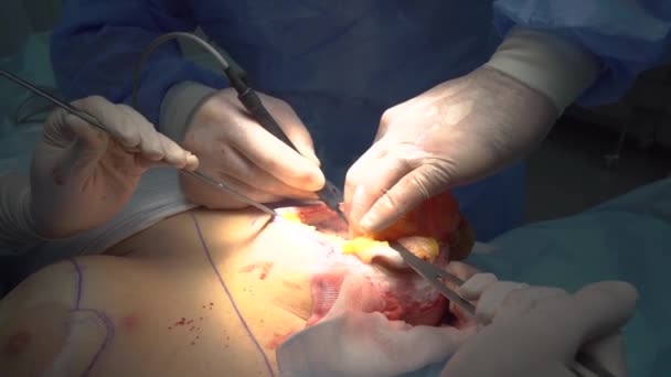 Extraction of an old implant from a breast — Stock Video
