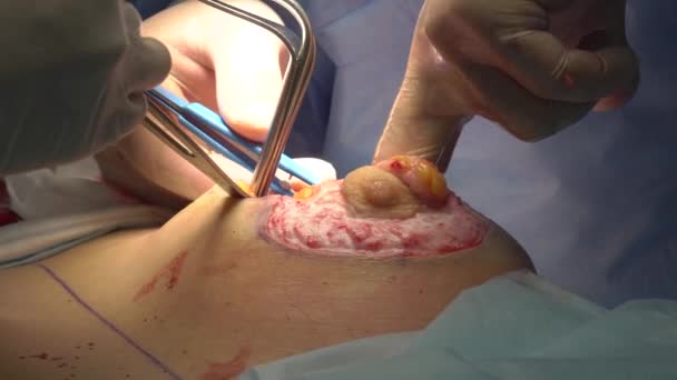 Χειρουργική επέμβαση για να αλλάξετε το σχήμα του στήθους σε μια γυναίκα. — Αρχείο Βίντεο