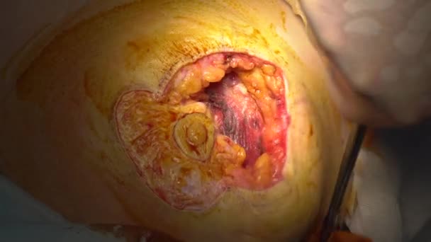 Cirurgia para mudar a forma do peito em uma mulher . — Vídeo de Stock