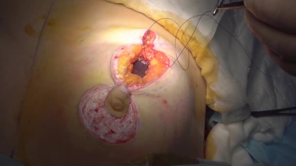 Surgery to change the shape of the breast in a woman. — Stock Video