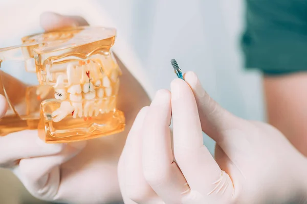 Dentist Holding Dental Implat — Stock Photo, Image