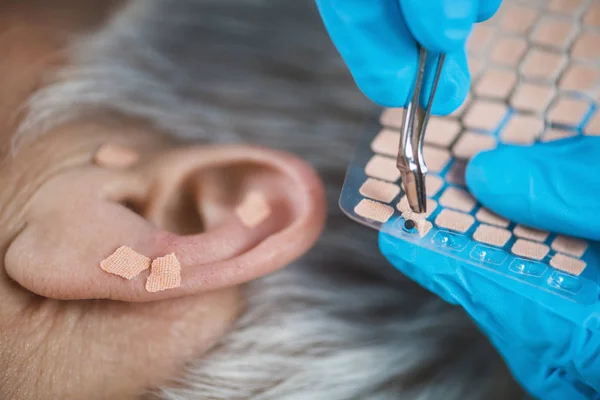 耳部治疗 或对人耳的眼膜治疗 治疗师手应用针灸耳籽贴纸与钳子 — 图库照片