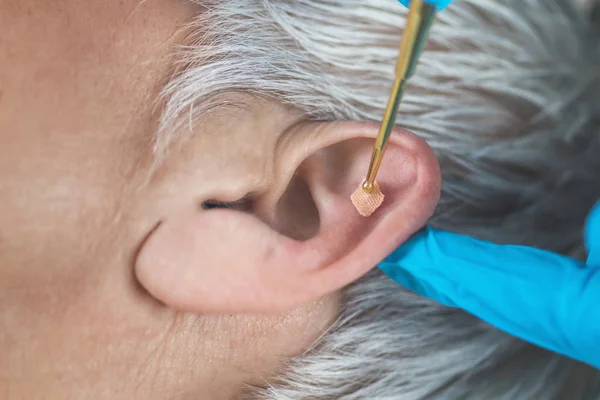 Auricoloterapia Trattamento Auricolare Sull Orecchio Umano Con Penna Auricolare Ottone — Foto Stock