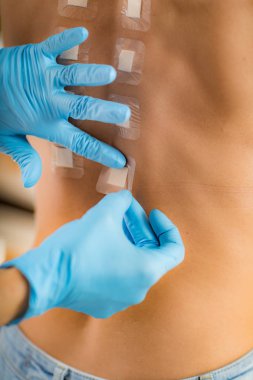 Bağışıkolog Bir Kadın Geri Cilt Prick Alerji Testi Yapıyor 