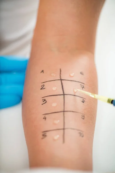 アレルギー 女性の腕の皮膚プリックテスト — ストック写真