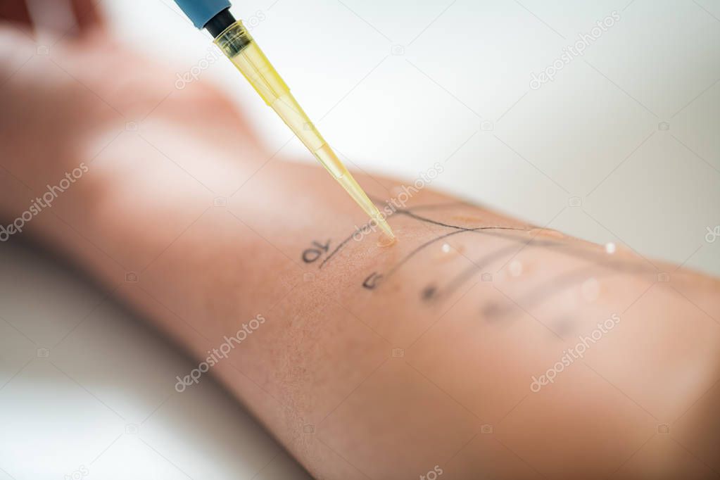 Allergy - Skin Prick Tests on a Womans Arm 