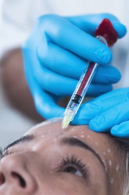 Hyaluronik asit enjeksiyonları. Güzel olgun bir kadın alnındaki çizgileri azaltmak için hyaluronan iğnesi olur. Yaşlanma karşıtı kavram. 