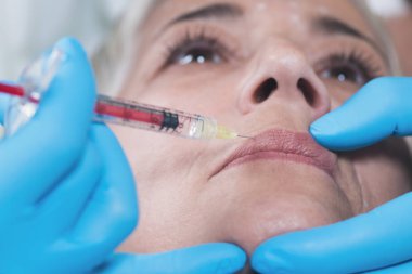 Hyaluronik enjeksiyonlar. Güzel, olgun bir kadın, ağız ve dudak çevresindeki kırışıklıkları azaltmak için hyaluronan iğnesi olur. Yaşlanma karşıtı kavram.  