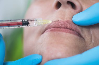Hyaluronik enjeksiyonlar. Güzel, olgun bir kadın, ağız ve dudak çevresindeki kırışıklıkları azaltmak için hyaluronan iğnesi olur. Yaşlanma karşıtı kavram.  