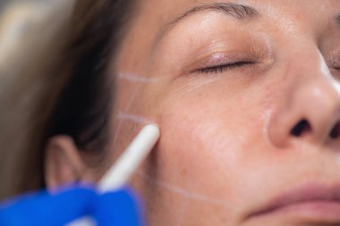 Estetik Tıp Kliniğinde Mezoterapi gören Kadın
