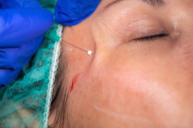 Estetik Tıp Kliniğinde Mezoterapi gören Kadın