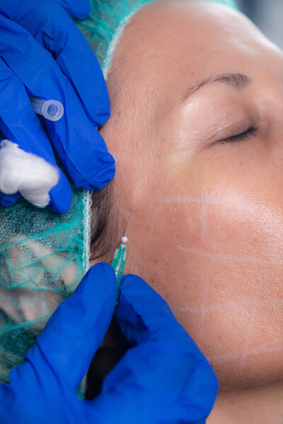 3D Meso Threads for Face Lifting and Contouring. Aesthetic Medicine Concept.