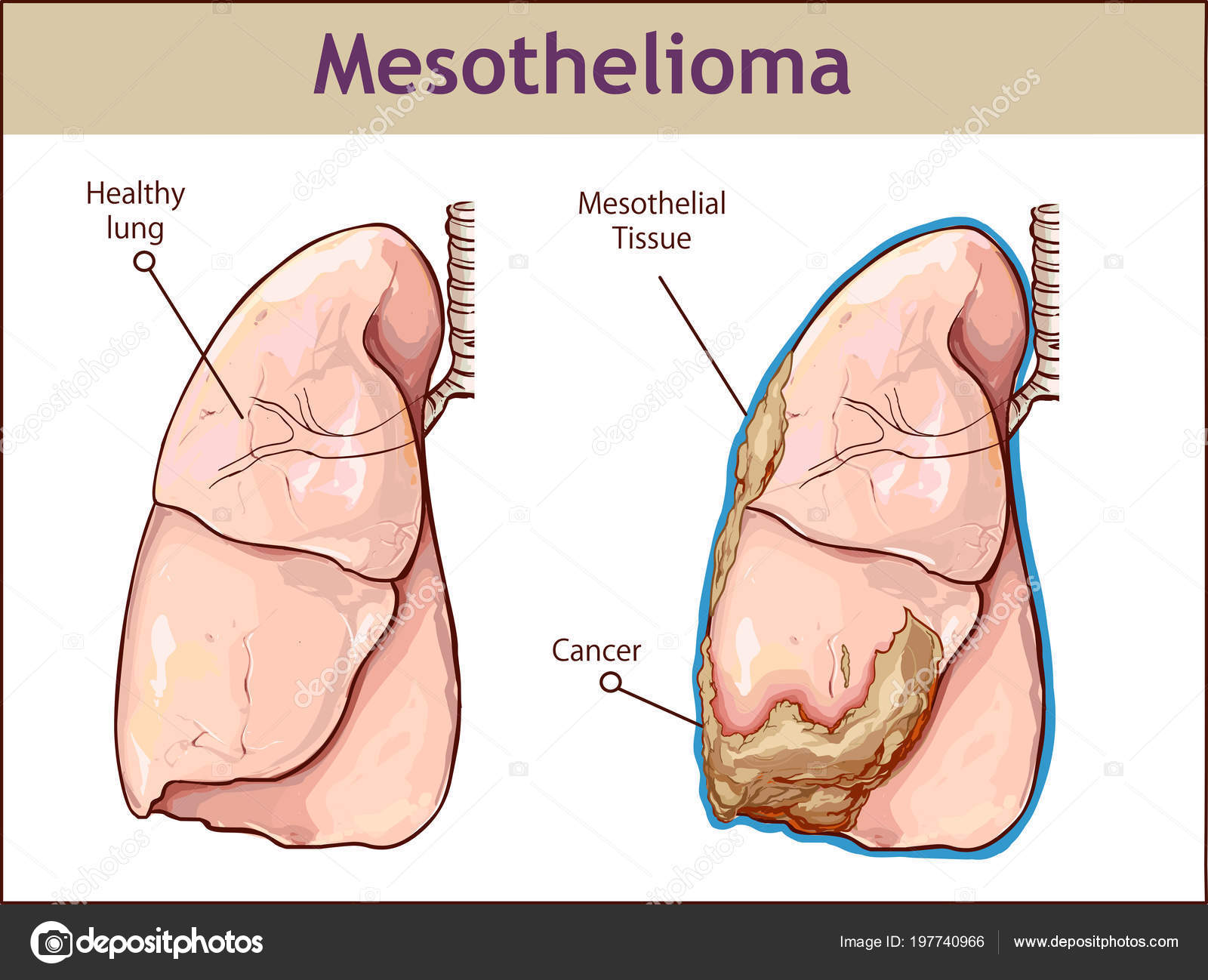 can you survive stage 4 rectal cancer