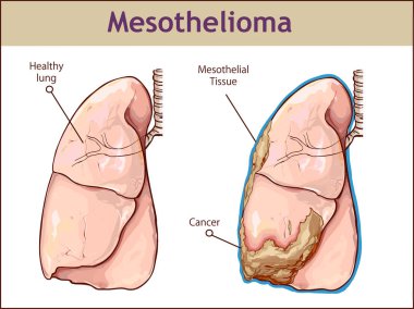  Plevral mezotelyoma vektör çizim.