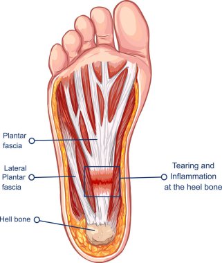  Vector  illustration of a Plantar Fasciitis clipart