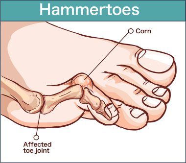 bir hammertoes vektör çizim .
