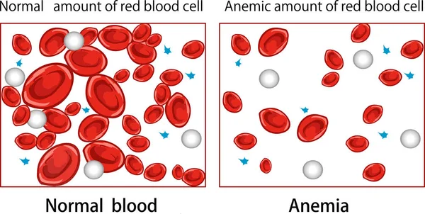 Illustrazione Vettoriale Diagramma Anemia — Vettoriale Stock