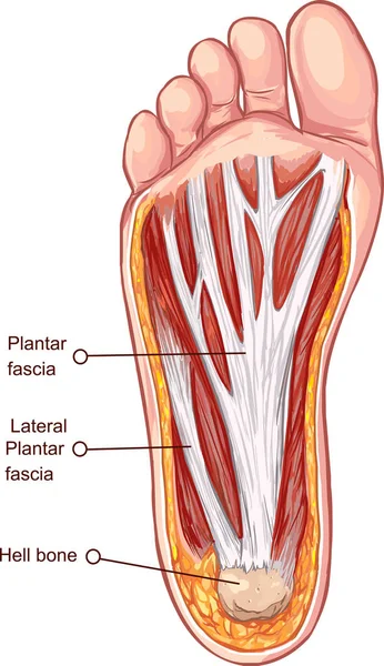 Vektorillustration Einer Plantarfaszitis Illustration — Stockvektor