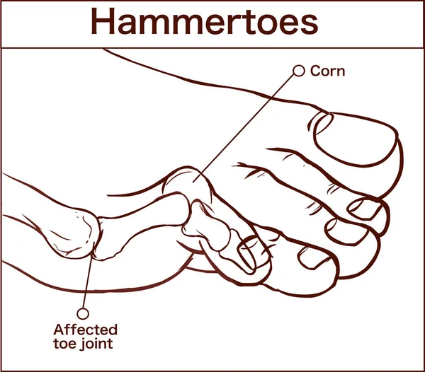 Ilustração Vetorial Hammertoes —  Vetores de Stock