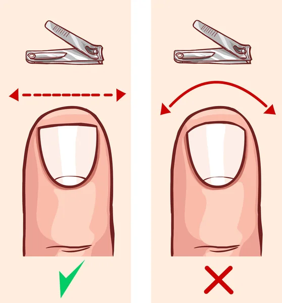 Korrekta Och Felaktiga Nageln Cut — Stock vektor