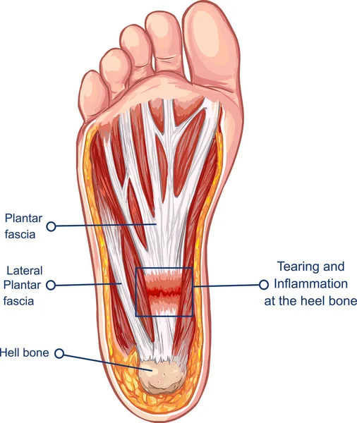 Vectorillustratie Van Een Plantaire Fasciitis — Stockvector