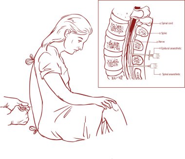 Epidural sinir bloğu enjeksiyon