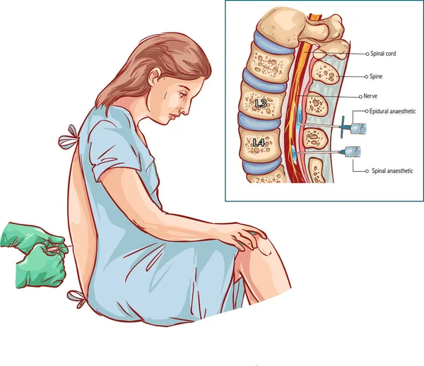 Epidural Sinir Bloğu Enjeksiyon — Stok Vektör