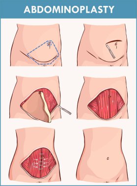 Abdominoplasty and Lipectomy Procedures clipart