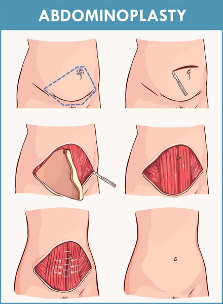 Abdominoplasty Lipectomy Procedures — Stock Vector